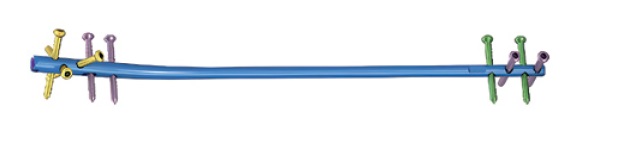 Блокуючий гомілковий стрижень Jinlu